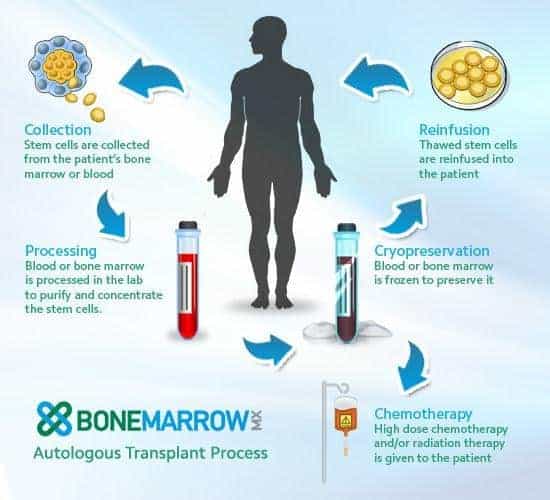 autologous stem cell transplant