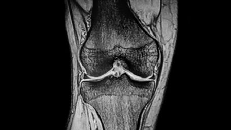 CT Scan of knee